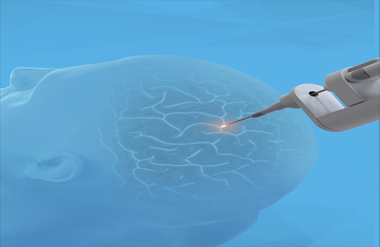 Monteris Medical secures 28 million dollars in Series E funding for robotic neurosurgery technology